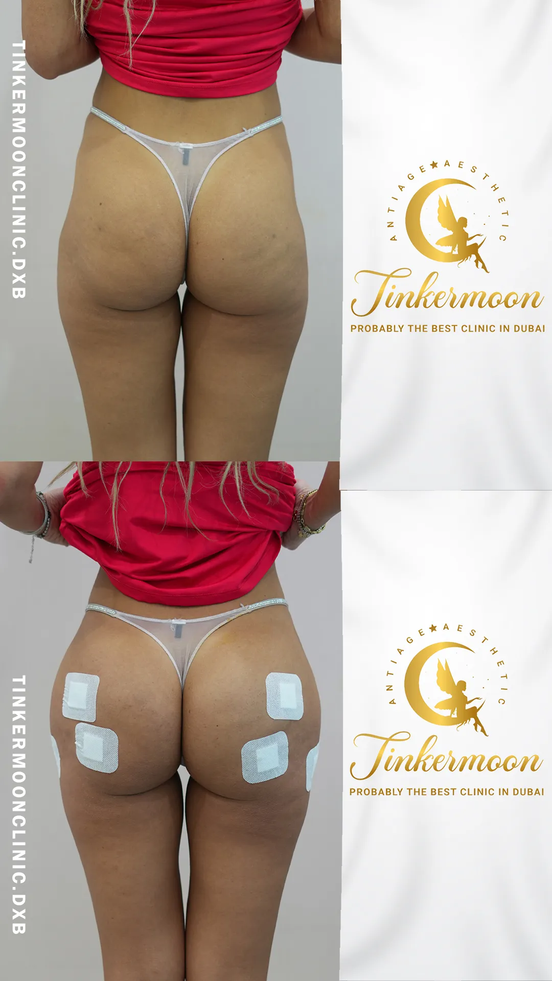 Before and after butt enhancement showing visible volume improvement at Tinkermoon