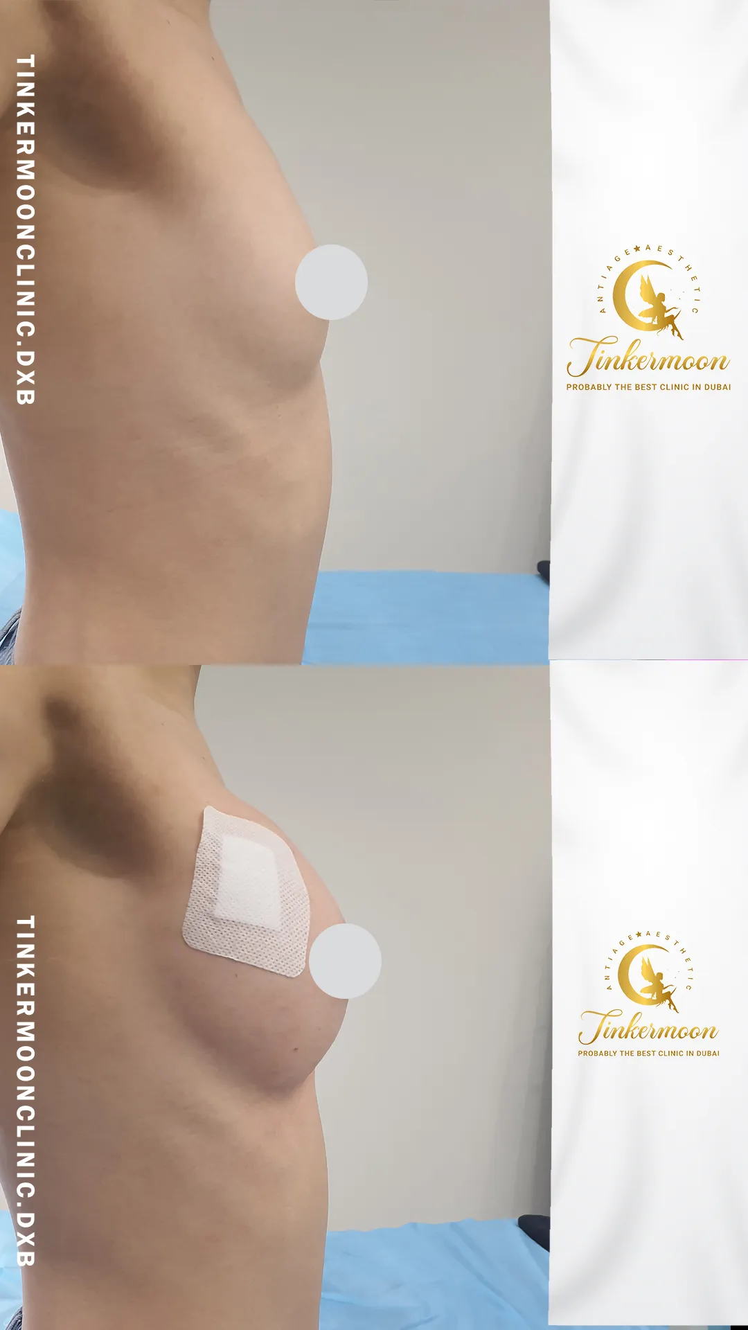 Before and after breast filler showing visible volume enhancement at Tinkermoon Clinic