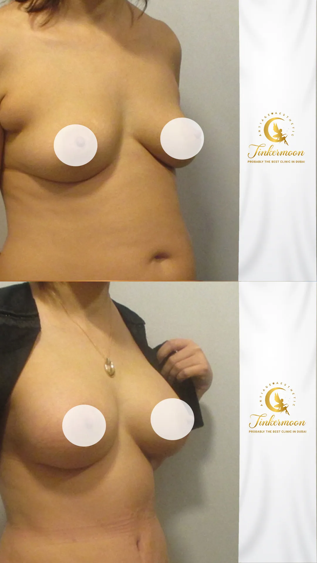 Before and after breast augmentation showing lifted, fuller results at Tinkermoon Clinic
