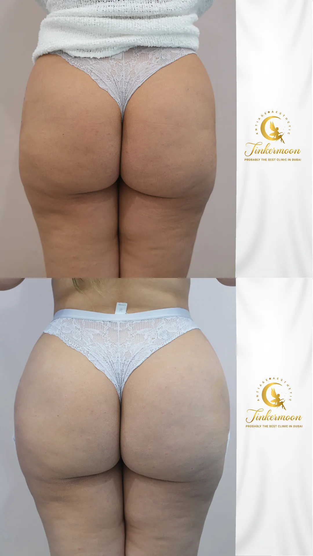 Before and after butt filler results showing lifted and fuller shape at Tinkermoon Clinic