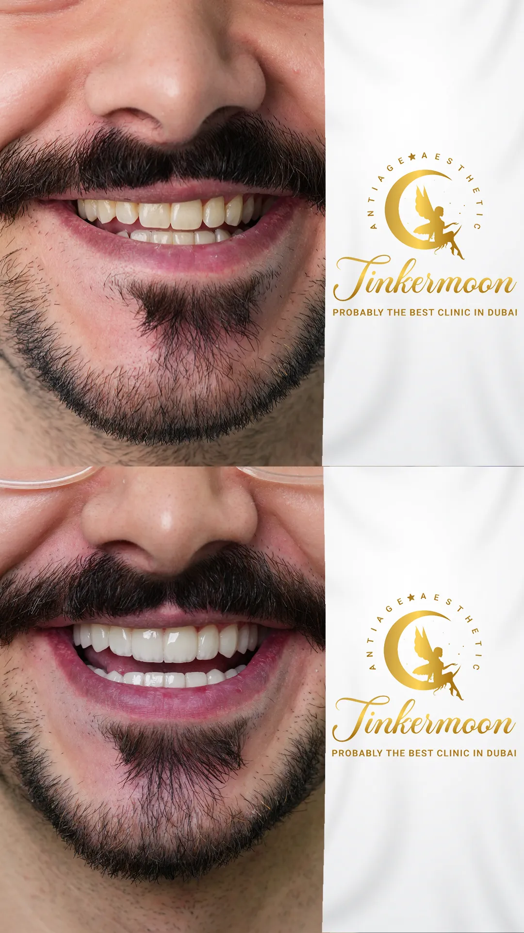Before and after smile transformation showing whiter, aligned teeth at Tinkermoon Clinic