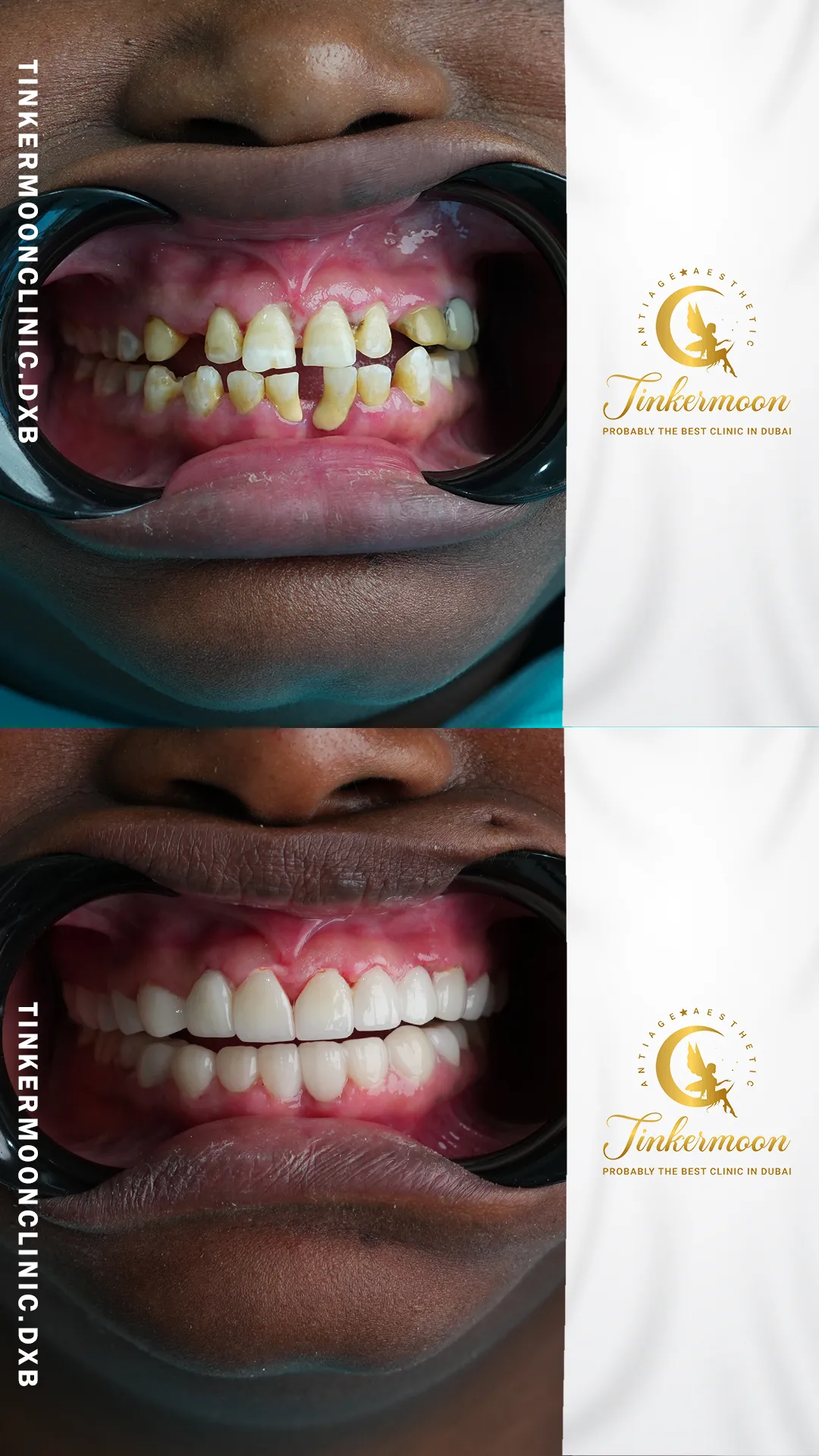Before and after dental restoration showing aligned, whitened teeth at Tinkermoon Clinic
