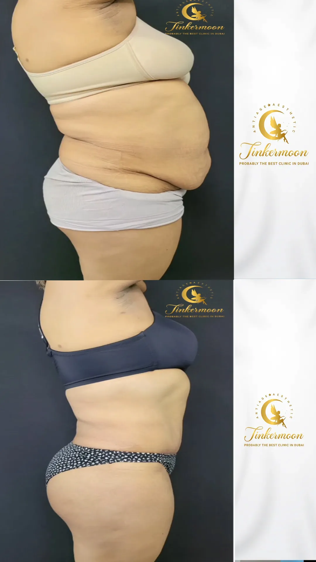 Before and after body slimming results showing reduced belly fat and toned waist at Tinkermoon Clinic