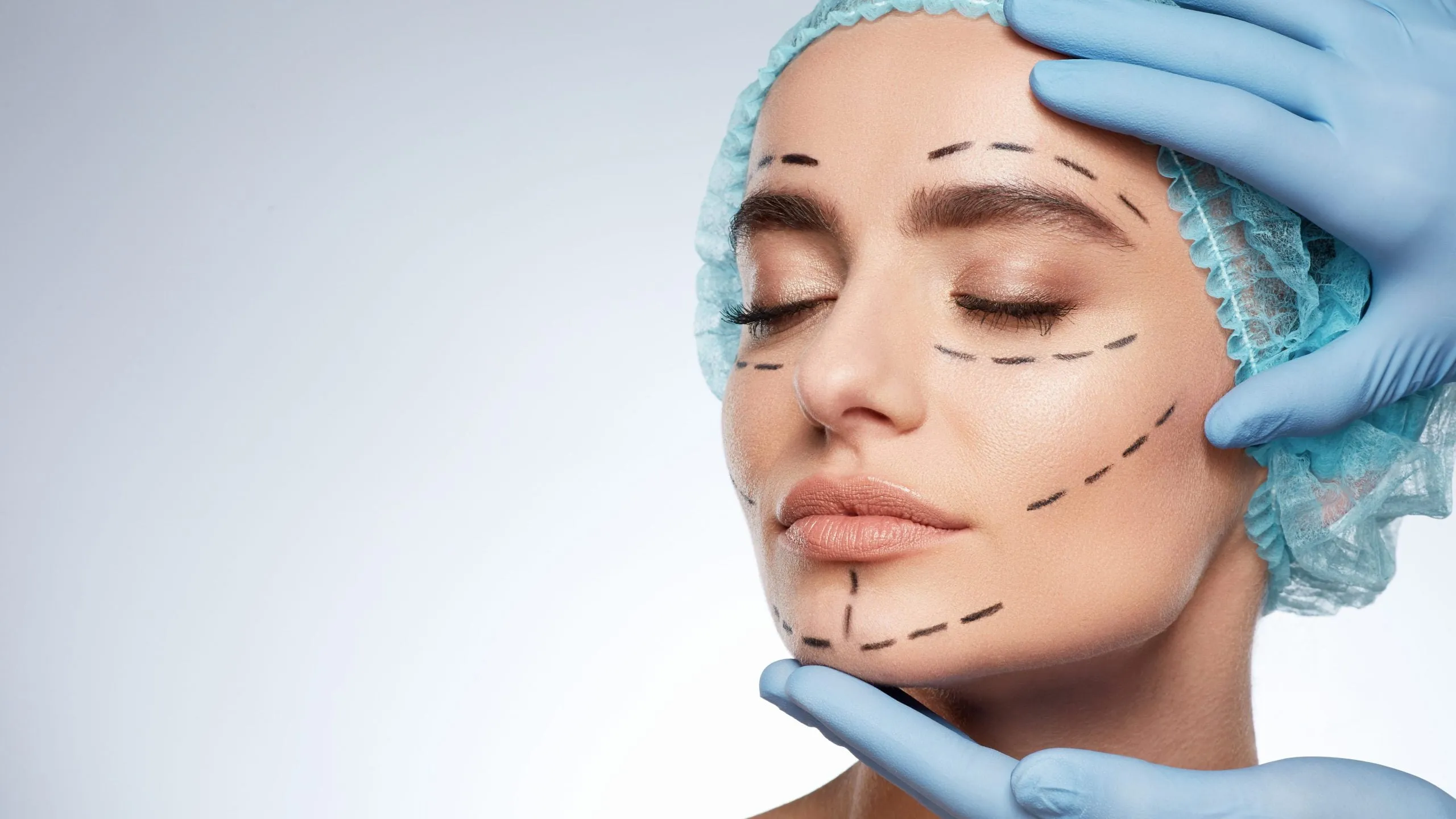 Female patient with surgical markings on face before cosmetic procedure