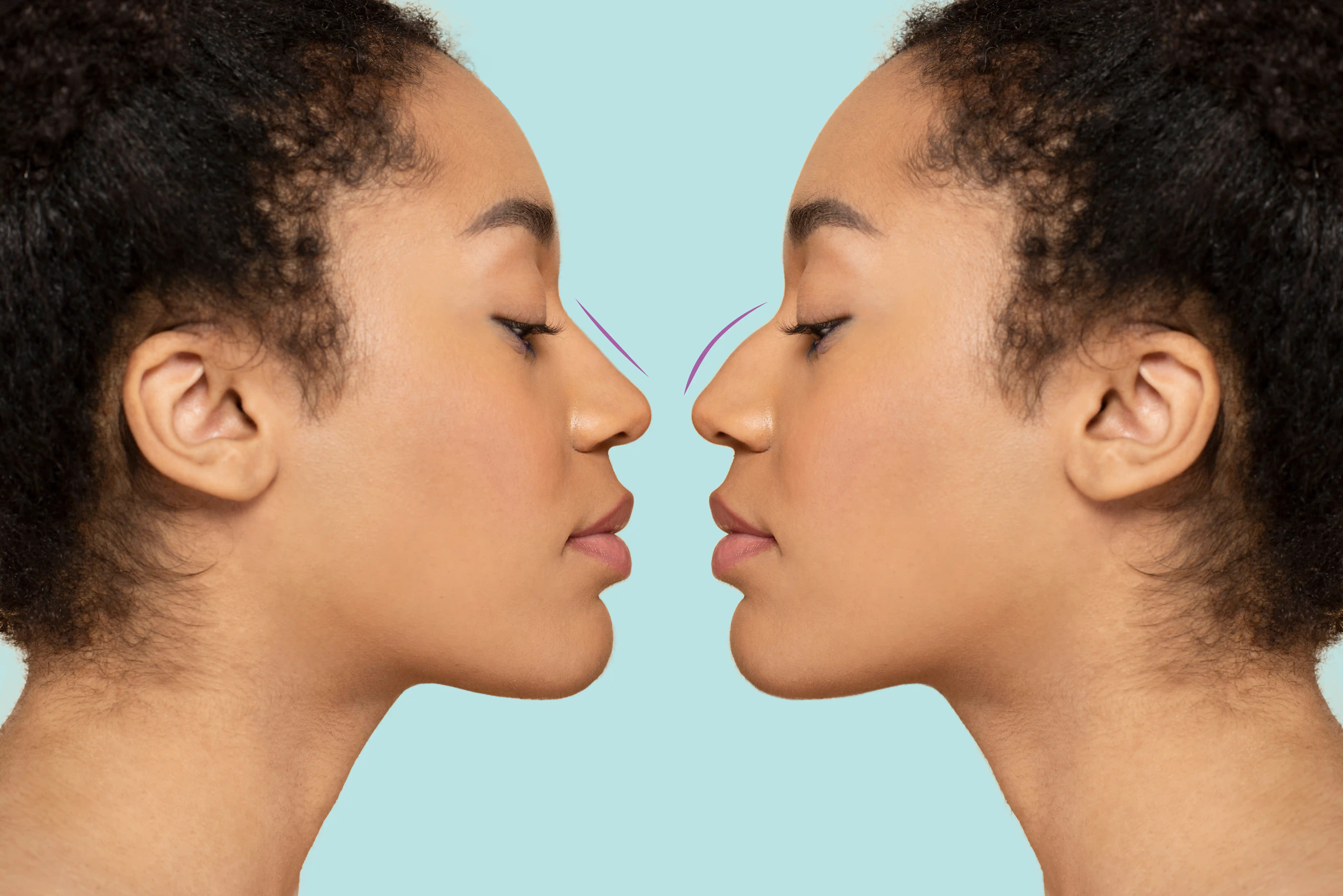 Before and after rhinoplasty concept showing nose reshaping on mirrored female profile